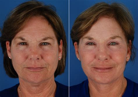 Eyebrow And Forehead Photos Naples Fl Patient 10653