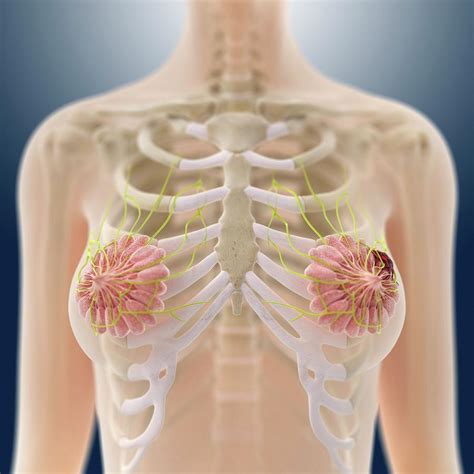 Breast Cancer Photograph By Springer Medizin Science Photo Library Fine Art America
