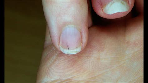 Pictures Of Infected Finger Around Nail Nail Infection Bacterial