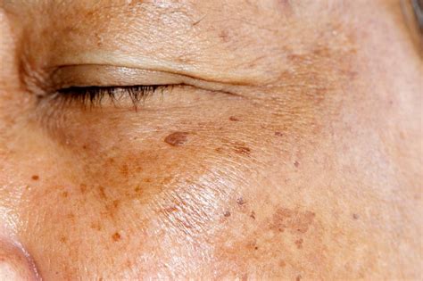 How To Treat Hyperpigmentation Dark Spots And Uneven Skin Tone A