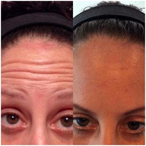 Botox Before And After Pictures Forehead 4 Facelift Info Prices