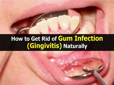How To Get Rid Of Gum Infection Gingivitis Naturally