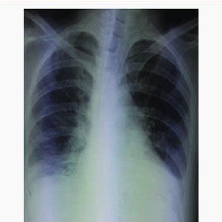Brian pallister wants the public to get so frustrated with a kneecapped and incapable public healthcare system (that his party will ensure is incapable and ineffective) so that he can bring in the argument for. Facial bone 3D CT showed panfacial fracture. CT: computed ...