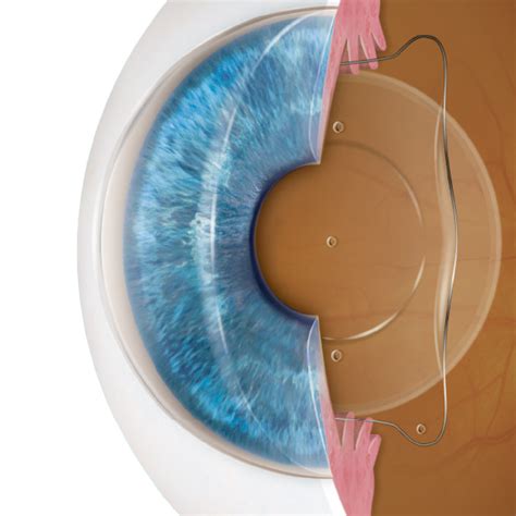 Implantable Contact Lens — Kieren Darcy · Ophthalmologist · Vision Correction Cornea Cataract