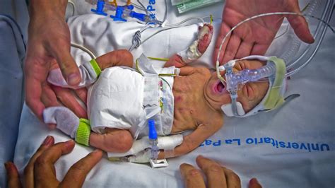 At 10 weeks, a baby is as big as a strawberry or a kumquat! Premature births 'an unrecognised killer' - Channel 4 News