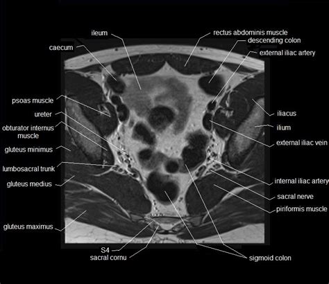Mri pelvis anatomy | free male pelvis axial anatomy from mrimaster.com start studying mri anatomy pelvis. MRI pelvis anatomy | free male pelvis axial anatomy