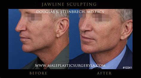 Chiseled Jawline Gallery Male Plastic Surgery Los Angeles