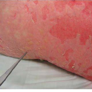 Toxic Epidermal Necrolysis In A Female Patient Covering More Than 30