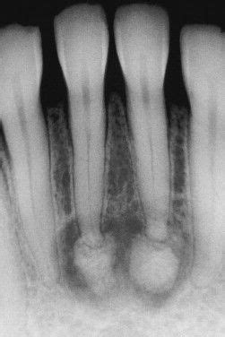 Pilot evaluation of a nonsurgical treatment for cervical dysplasia //gynecologic oncology. Periapical Cemento-Osseous Dysplasia. Later-stage lesions ...