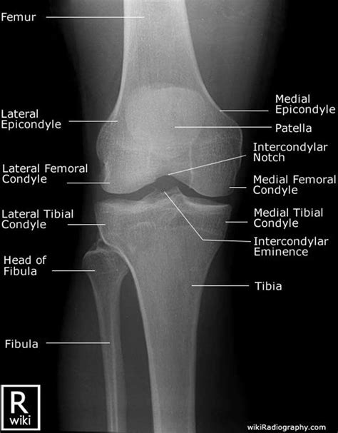 Normal Knee X Rays Bone And Spine Images And Photos Finder