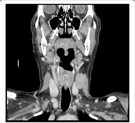 Computed Tomography Coronal Plane Of The Patients Left Lateral Neck