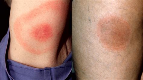 Types Of Rashes That Can Be Signs Of Lyme Disease Lyme Disease My Xxx