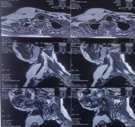 Figure 2 From A Case Report Of Giant Anterior Neck Lipoma Semantic