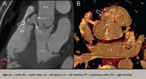 Aortic Root Fistula Complicating Infective Endocarditis Role Of 64
