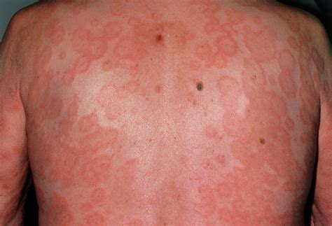 erythema multiforme skin rash on back of male photograph by dr p marazzi science photo library