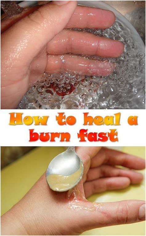 15 Effective Home Remedies To Treat Minor Burns At Home Fast In 2020