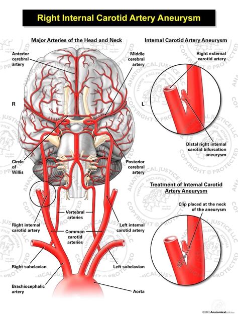 The carotid arteries provide the head's blood supply and run along both sides of the neck. Right Internal Carotid Artery Aneurysm Illustration | Anatomical Justice