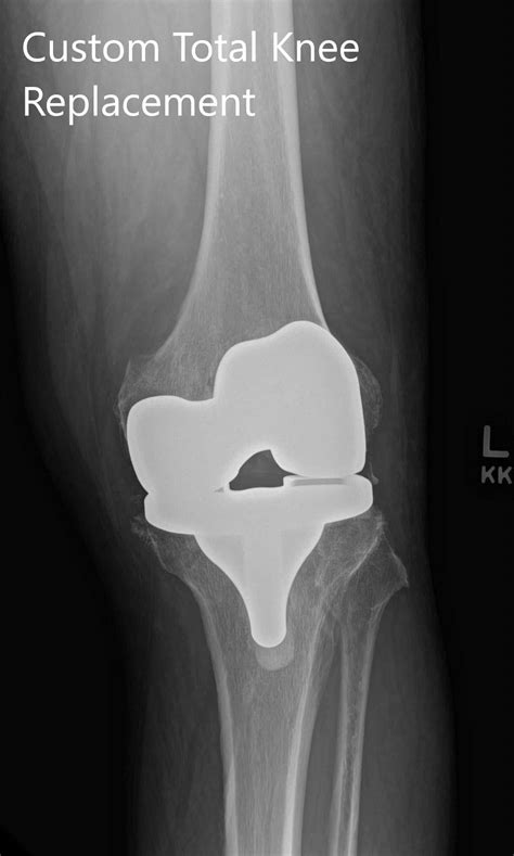 Case Study Custom Left Knee Replacement In 66 Yr Old Male