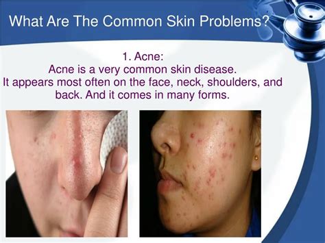 Ppt What Are The Common Skin Problems Powerpoint Presentation Id