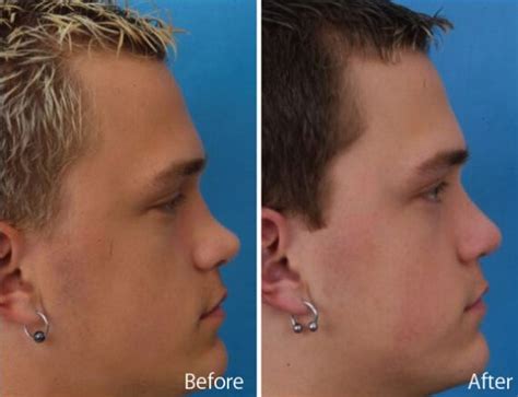 Upturned Nose Before And After Photos Becker Rhinoplasty Center