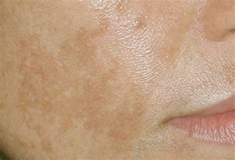 Remove Brown Spots On The Skin Help Home Remedies Random News