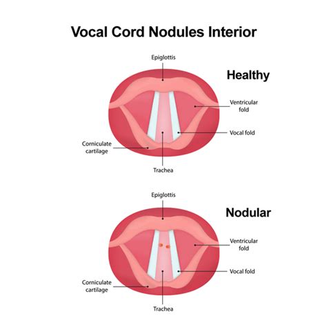Vocal Cord Nodules Baltimore Md Owings Mills Md