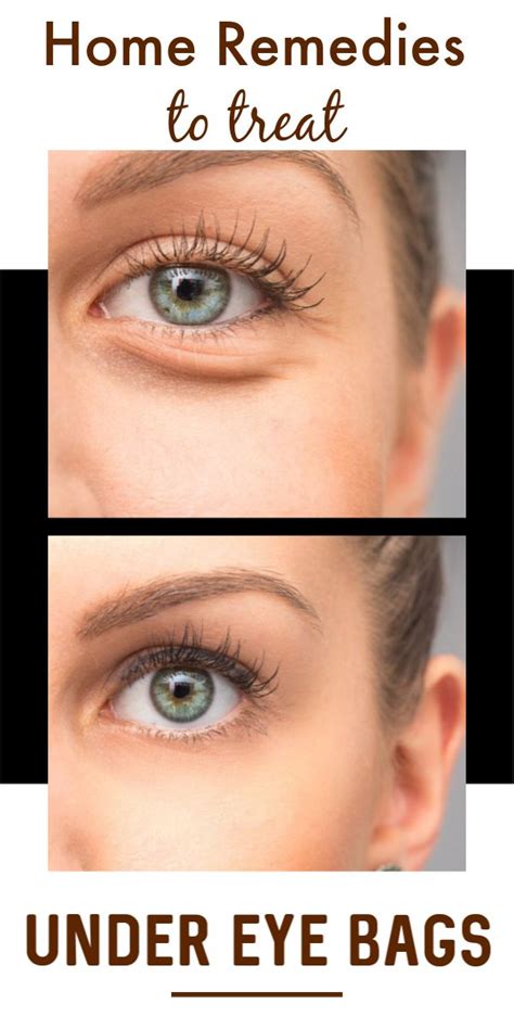 3 Best Home Remedies To Treat Under Eye Bags At Home In 2021 Eye Bags