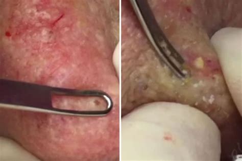 They wear gloves and lance a pimple with a sterile needle, then remove the contents with an instrument called a comedone extractor. Dr Pimple Popper - Latest news updates, pictures, video ...