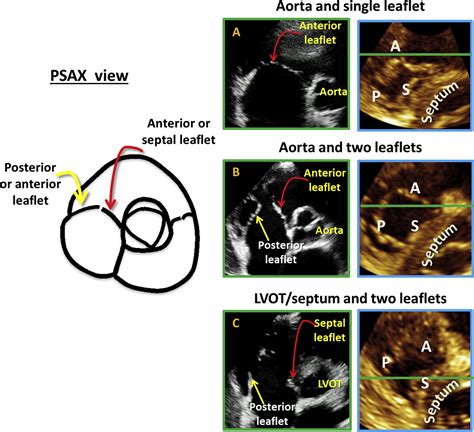 Comprehensive Two Dimensional Interrogation Of The Tricuspid Valve