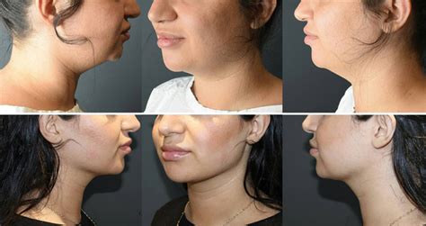 Fixing A Weak Jawline With Cosmetic Surgery Cosmos Clinic
