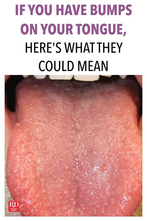 White Painful Bump On Tongue Lasopaairport