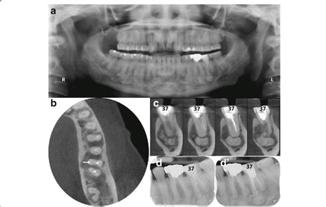 Stage Fod With Concomitant Endodontic Periapical Lesion On Download Scientific Diagram