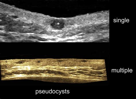 Imaging Of Hidradenitis Suppurativa Dermatologic Clinics