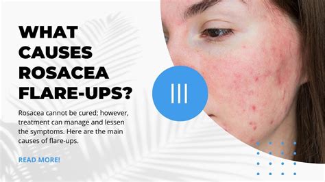 Understanding The Main Causes Of Rosacea Flare Ups