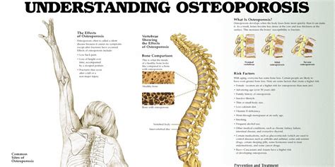 An increased risk of kidney stones. Calcium and Vitamin D Combination to Reduce Osteoporosis Risk