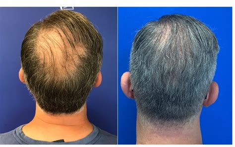 Best Male Hair Loss Treatment Options In Cami