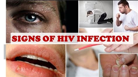 5 common hiv symptoms in men ladies see how to know if he s hiv positive check no 3