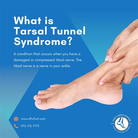 What Is Tarsal Tunnel Syndrome Foot And Ankle Centers Of Frisco And Plano