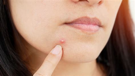 Pimples That Do Not Go Away Causes And Treatment