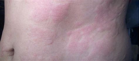 Adding A Steroid May Not Be Necessary In Acute Urticaria Management Mpr