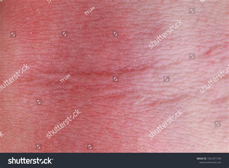 Allergic Rash Dermatitis Eczema Skin Texture Stock Photo 1061071769