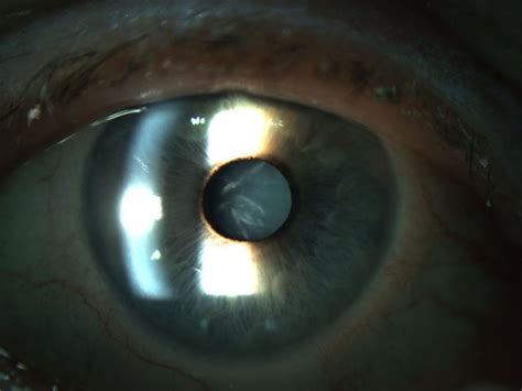 Bei der häufigsten kataraktform, der schnell fortschreitenden rindenkatarakt (cataracta corticalis), entstehen flüssigkeitsgefüllte vakuolen, die eine trübung der linsenrinde auslösen. Dictionnaire d´Ophtalmologie - Praxis Zeitz Franko Zeitz ...