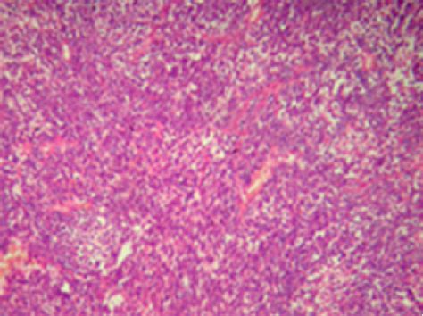 Figure 1 From Synovial Sarcoma On The Anterior Abdominal Wall