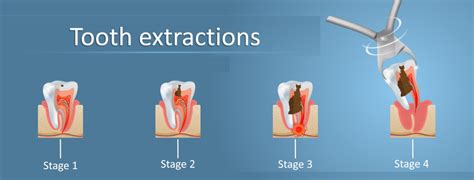 Tooth Extraction Huntington Beach Ca Pain Relief With Oral Surgery