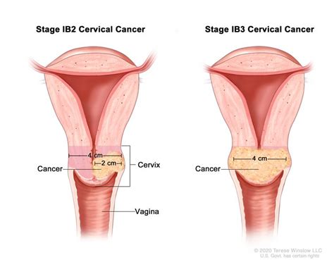 Adenocarcinoma Cervical Cancer Survival Rates