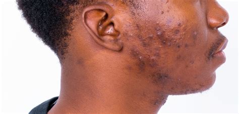 Skin Disorders Pictures Symptoms Causes And Treatment
