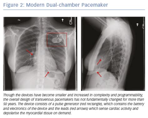 Modern Dual Chamber Pacemaker Radcliffe Cardiology