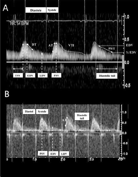 Pulse Wave Doppler Echocardiography Of Abdominal Aorta A Before