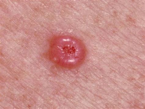 Skin Cancer Types Basal Cell Carcinoma Types Of Skin Cancer Oncobeta