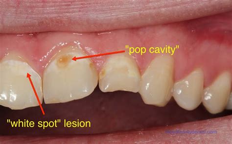 Symptoms of these cavities include sensitivity to cold or Dental Care Tips To Heal Cavities Naturally At Home ...